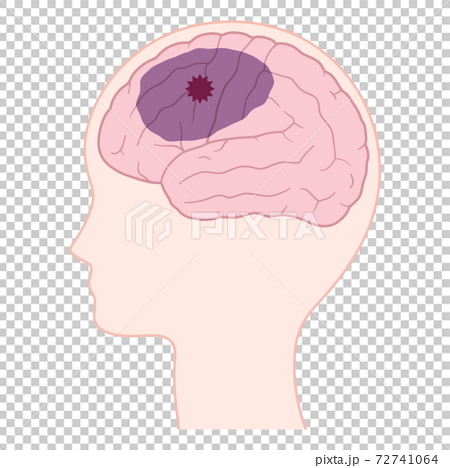 脳血管性認知症の脳のイラストのイラスト素材
