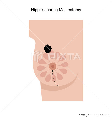 Breast disease concept 72833962