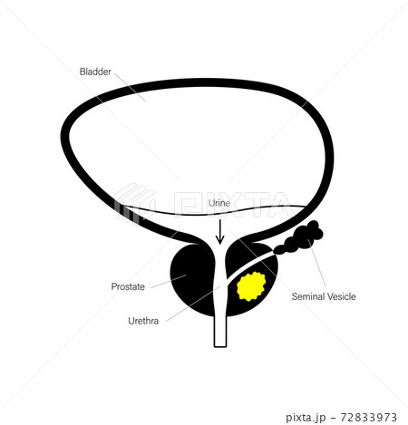 Prostate cancer concept Prostate cancer concept 72833973