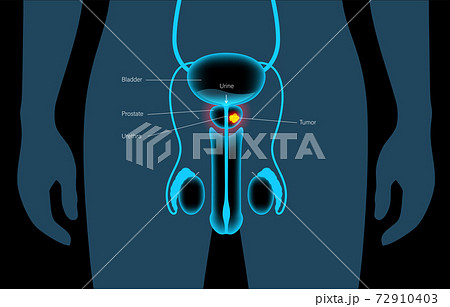 Prostate cancer concept 72910403
