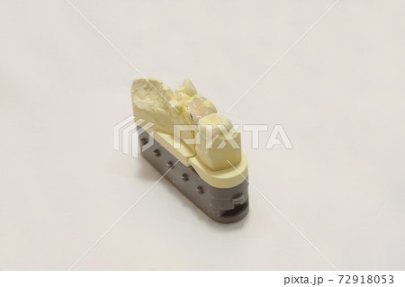 奥歯の歯科用セラミックインレー 72918053