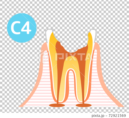 Caries and Progression and Treatment: Dental Illustration 72921569