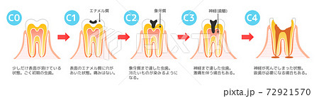 虫歯と進行と治療:歯科のイラスト 72921570