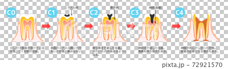虫歯と進行と治療:歯科のイラスト 72921570