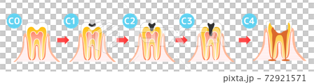 Caries and Progression and Treatment: Dental Illustration 72921571
