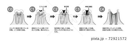 印刷用白黒版 虫歯と進行と治療 歯科のイラストのイラスト素材 印刷用白黒版 虫歯と進行と治療 歯科のイラストのイラスト素材