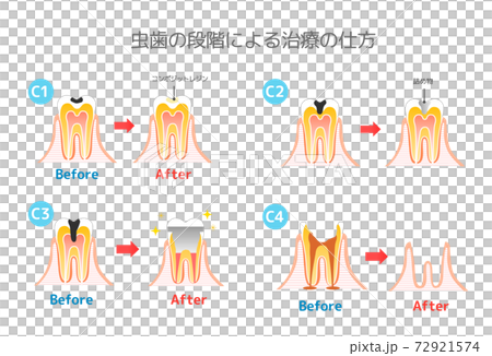 Caries and Progression and Treatment: Dental Illustration 72921574