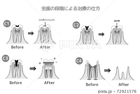印刷用白黒版 虫歯と進行と治療 歯科のイラストのイラスト素材