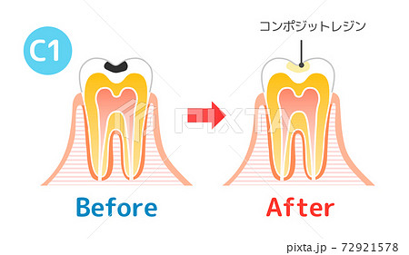 虫歯と進行と治療 歯科のイラストのイラスト素材