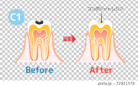 虫歯と進行と治療:歯科のイラスト 72921578