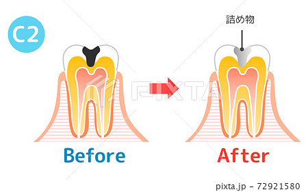 虫歯と進行と治療:歯科のイラスト 72921580