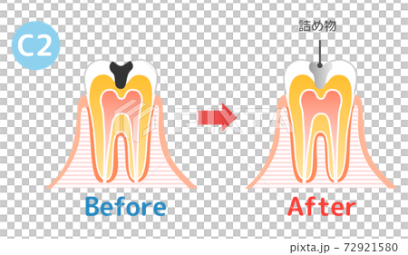 虫歯と進行と治療:歯科のイラスト 72921580
