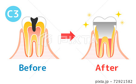 虫歯と進行と治療 歯科のイラストのイラスト素材