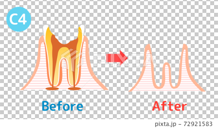 Caries and Progression and Treatment: Dental Illustration 72921583