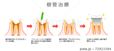 根管治療 虫歯と進行と治療:歯科のイラスト 72921584