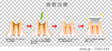 Root Canal Treatment Caries and Progression and Treatment: Dental Illustration 72921584