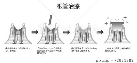 印刷用白黒版 虫歯と進行と治療 歯科のイラストのイラスト素材
