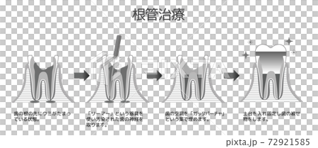 Black and White Printed Caries and Progression and Treatment: Dental Illustrations 72921585
