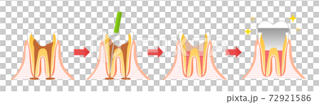 Caries and Progression and Treatment: Dental Illustration 72921586