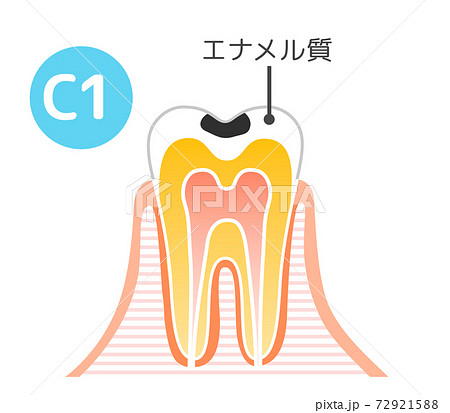 虫歯と進行と治療:歯科のイラスト 72921588