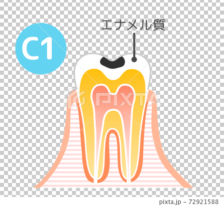 虫歯と進行と治療:歯科のイラスト 72921588