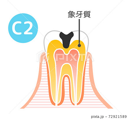 虫歯と進行と治療:歯科のイラスト 72921589