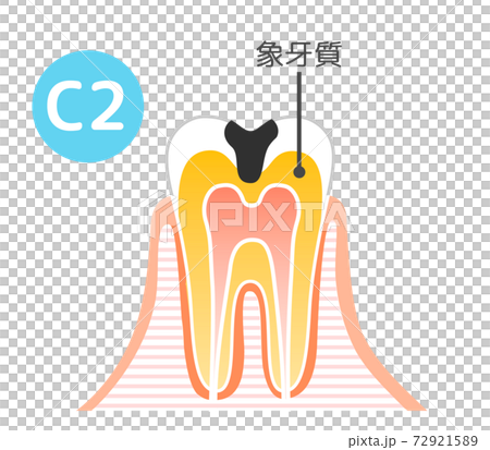 虫歯と進行と治療:歯科のイラスト 72921589