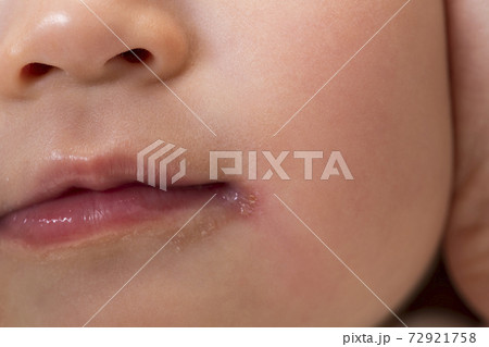 子どもの口の周りの皮膚の荒れ 72921758