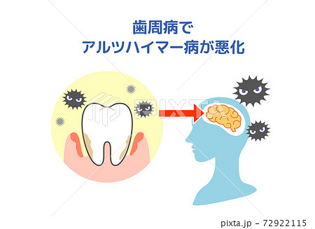 歯周病とアルツハイマー病の関係 歯周病とアルツハイマー病の関係 72922115