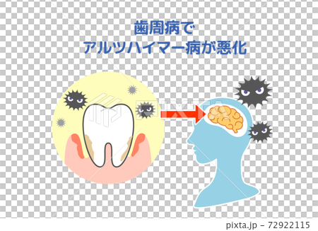 歯周病とアルツハイマー病の関係のイラスト素材