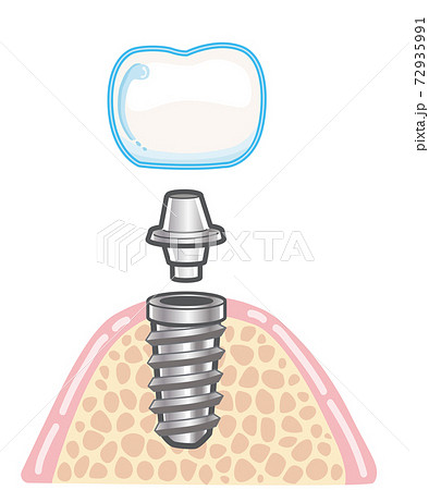 人工歯根 インプラント イラストのイラスト素材