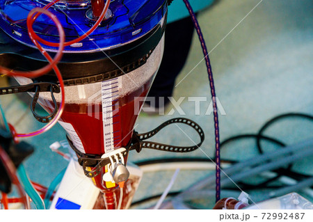 Apparatus circulation blood heart lung machine for heart surgery in operating room 72992487