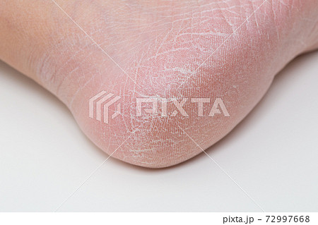 かかとの角質　ひび割れ　ガサガサ 72997668