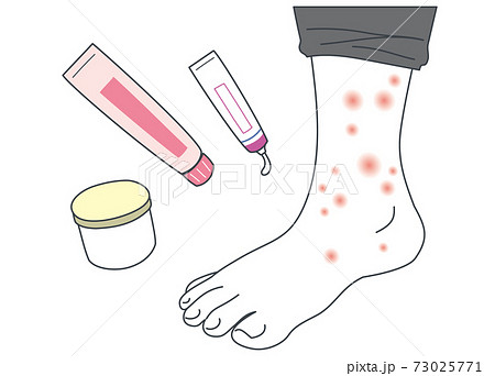 アトピー・虫刺され・湿疹ができた足を薬で治療するイラスト 73025771
