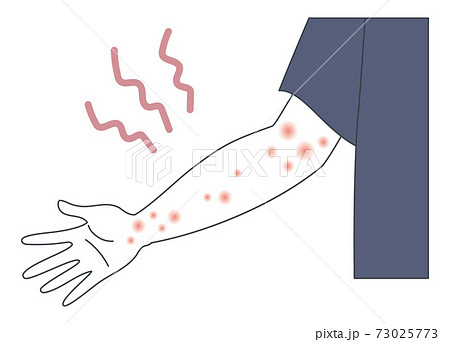 アトピー・蕁麻疹・帯状疱疹・湿疹ができた腕のイラスト アトピー・蕁麻疹・帯状疱疹・湿疹ができた腕のイラスト 73025773