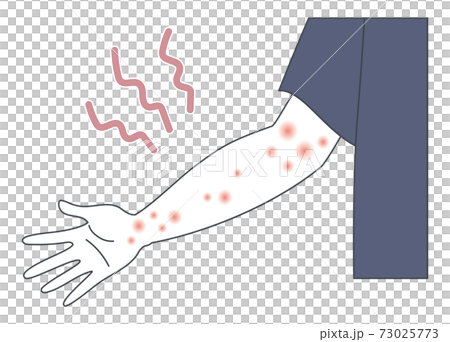 アトピー・蕁麻疹・帯状疱疹・湿疹ができた腕のイラスト アトピー・蕁麻疹・帯状疱疹・湿疹ができた腕のイラスト 73025773