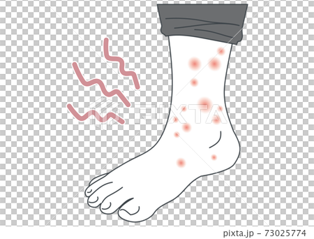 アトピー・蕁麻疹・帯状疱疹・湿疹ができた足のイラスト 73025774