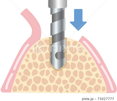 インプラント治療手術イラスト 73027777