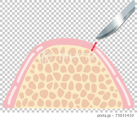Implant treatment incision surgery illustration 73031410