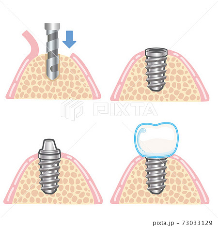 インプラント一回法イラストのイラスト素材