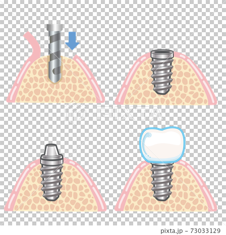 Implant one-time method illustration 73033129