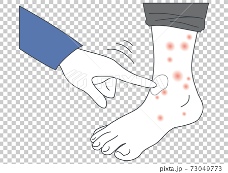 足の湿疹・アトピー・蕁麻疹に薬を塗るイラスト 73049773