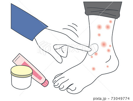 塗り薬で湿疹 アトピー 蕁麻疹を治療する足のイラストのイラスト素材