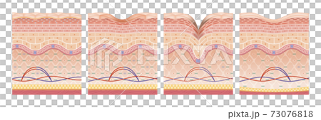 skin, skinned, cross-section diagram 73076818
