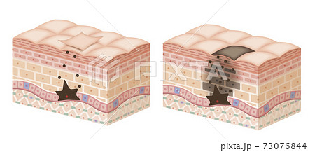 Cross section of the skin 2 No commentary Cross section of the skin 2 No commentary 73076844