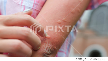 Bitten by mosquito in summer 73078596