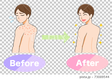 Illustration of a before-after man suffering from acne on his back 73089544
