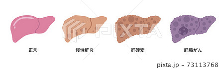 正常な肝臓　肝炎　肝硬変　肝臓がん 73113768
