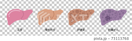 正常な肝臓　肝炎　肝硬変　肝臓がん 73113768