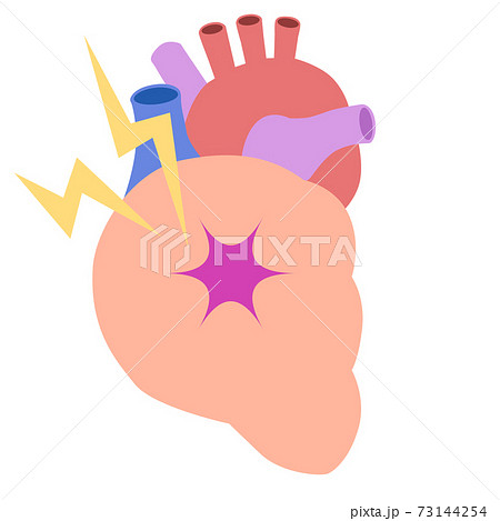 臓器_心臓の痛み 73144254